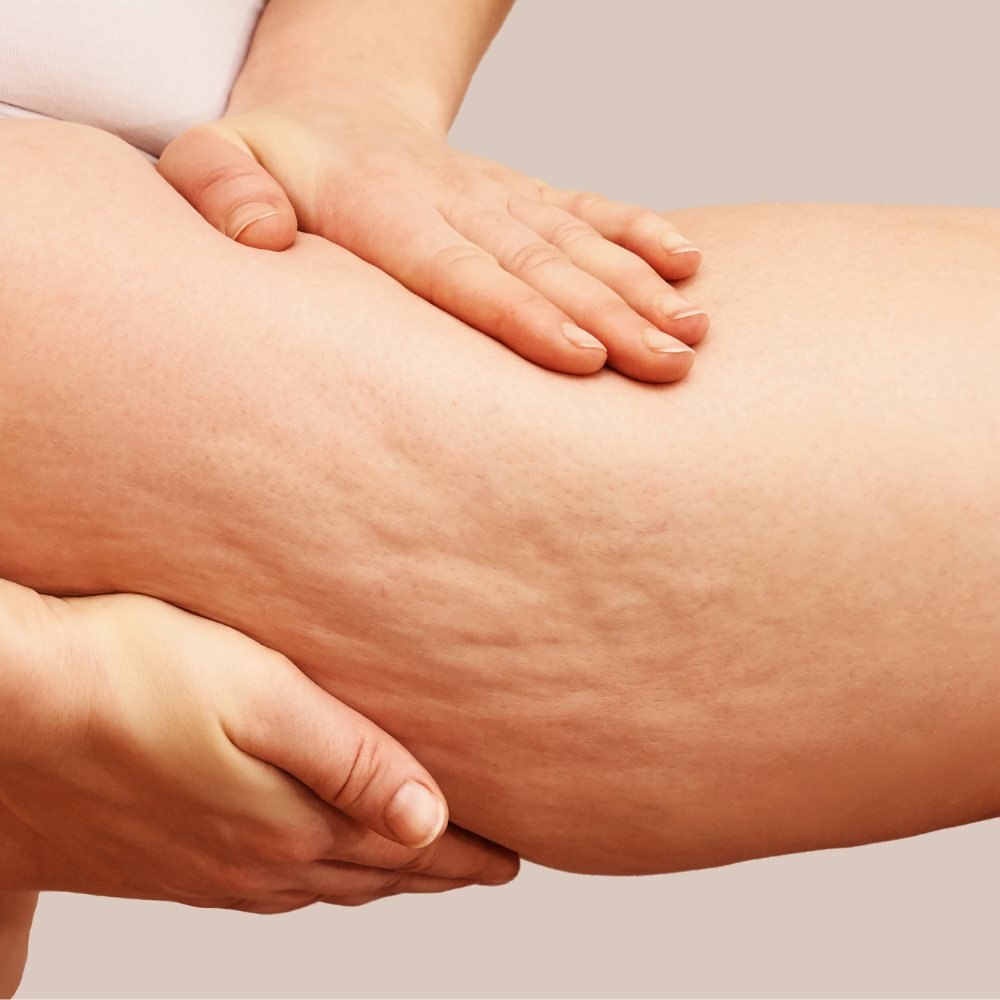 Μασάζ Κυτταρίτιδας